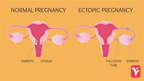 ectopic pregnancy 뜻